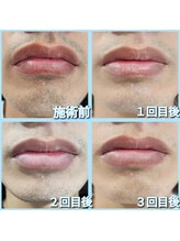 マイセルフ(myself)/ヒゲ脱毛施術例：30代