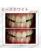 ミースホワイトニング(mys whitening)/ビフォーアフター【歯科提携】