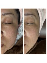 エステサロン オパール(OPALE)/話題のレモンボトルで小顔