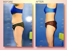 ジュリア オージェ 京都駅前店/ビフォーアフター（脂肪/サーモ)