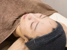 ライズボディ(Rise Body)/肌のお悩みに合わせて美容鍼も◎