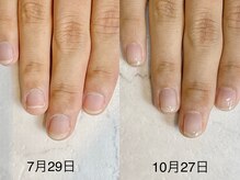 レヴィア(Revia)/深爪ケア 経過