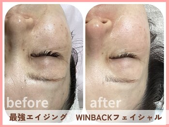 グロウ バイ フェイシャルデザイン アンド アイ(GROW)/お目元のたるみ、くま、しわ改善