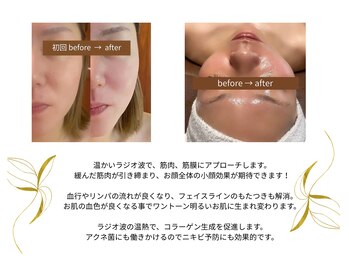 ラフォクシー(La.Foxy)/小顔コルギ