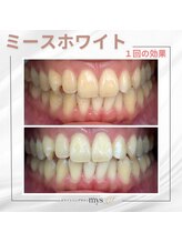 ミースホワイトニング(mys whitening)/ビフォーアフター【歯科提携】