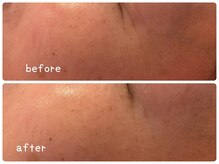 ヒメミ(Himemi)/BBL光エステ