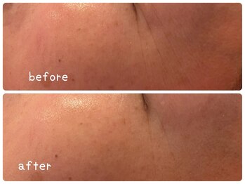 ヒメミ(Himemi)/BBL光エステ