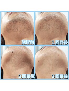 マイセルフ(myself)/ヒゲ脱毛施術例：30代