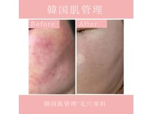 毛穴専科の雰囲気（インスタにビフォーアフター載せてます♪学割u24あり）