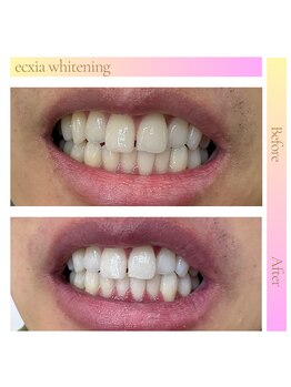 エクシアホワイトニング 原宿店/ホワイトニングビフォーアフター