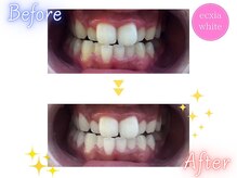 エクシアホワイトニング 新百合ヶ丘店/ホワイトニングビフォーアフター