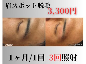 アップパイン(UPPINE)/眉スポット脱毛/¥3,300