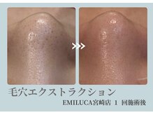 エミルカ 宮崎店(EMILUCA)の雰囲気（毛穴エステで角栓ゴッソリ＋ハーブピーリングで毛穴引き締め♪）