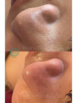 レーヌ(Reine)/毛穴エクストラクション