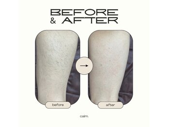 カルム(calm.)/☆メンズ脱毛☆膝上¥8000