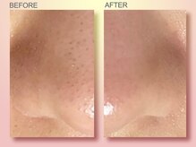 ジュリア オージェ 天王寺店/ビフォーアフター（鼻スパ）