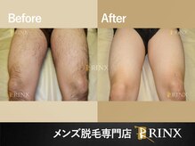 リンクス 北九州小倉店(RINX)/ボディ脱毛《メンズ脱毛RINX》