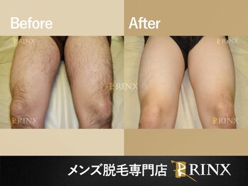 リンクス 北九州小倉店(RINX)/ボディ脱毛《メンズ脱毛RINX》