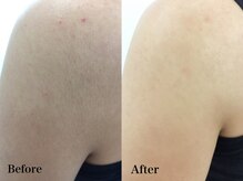 ラウレア 西条店(LAULEA)/腕脱毛before/after