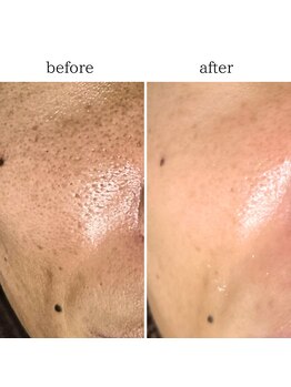 マーギアー(Magier)/ハーブピーリング初来店→５回目