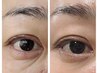 目のお悩みに！クマ、シワ改善、ゴルゴ線、眼精疲労/リフトアップeye目コース