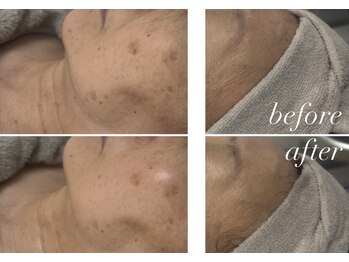 サロン ビュー(salon view)/ダクトピール/ビフォーアフター