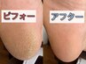 【夏に向けて、固くなったかかとを】フット角質ケア　￥7,000