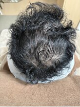 アマリージョヒラソル/Lit ヒト羊膜幹細胞