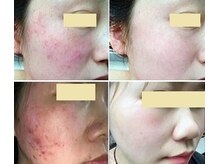 ナチュレアンドメディカ(Nature&Medica)/ニキビ専門ケア（プラズマ）