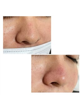 アンジェリック ウィング川崎店(Angelic)/鼻周りワックス