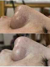 しらゆき 名古屋黒川/毛穴エクストラクション