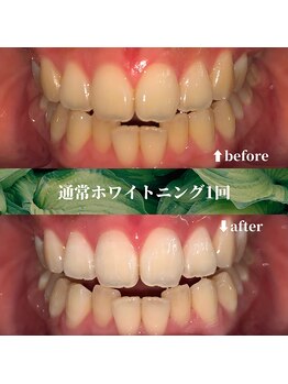 フタバ 天神大名店(futaba)/初回ホワイトニングbefore after