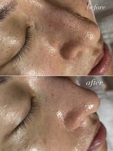 スパークル/フェイシャル/毛穴の開き/黒ずみ