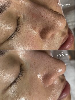 スパークル/フェイシャル/毛穴の開き/黒ずみ