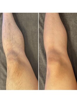 サロンド モーモ(SALON de mo-mo)の写真/【都度払い&低価格で通い易い★】クオリティの高い施術が高評価♪高機能脱毛機バイマッハ使用◎