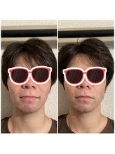 エクステンド鍼灸整体院(extend鍼灸整体院)/施術後　美容鍼　男性