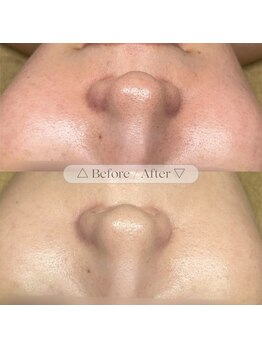 アール(R;)/毛穴悩みを解消！