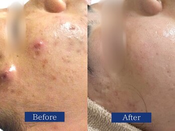 ビズビズ(bisebise)/メンズニキビ学割U24★大阪梅田