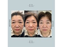 アルティ バイ ドルチェ(Ulti by dolce)の雰囲気（臍帯エクソソーム＆高純度エラスチン導入で最高美肌間違いなし！）