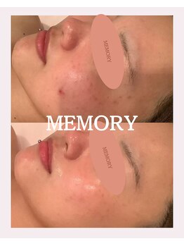 メモリー(MEMORY)/ニキビなどお肌質が改善！