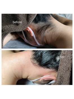 【光脱毛/WAX脱毛】doucek beauty/うなじワックス+光脱毛