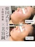 【至福の110分】深層肌よみがえる。韓国式ピーリング×美容鍼(贅沢パック付)