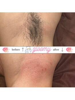 グルーミー(gloomy)/両脇ワックス脱毛♪