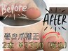【新メニュー】フット巻爪補正　導入キャンペーン　2本 【両足】