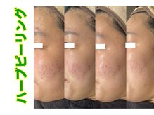 ブレア(Blair)/漢方ハーブピーリング