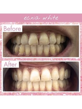 エクシアホワイトニング 武蔵小杉店/ビフォーアフター