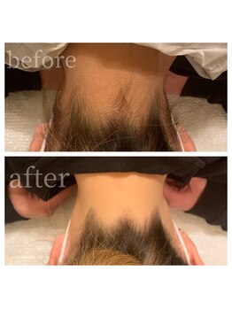 ミラージュ(Mirage)/うなじ 脱毛 ビフォーアフター