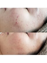 プシュケ(Psyche)/お客様の肌変化