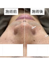 ウルル(ULuLu)/メンズフェイシャル