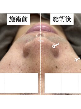 ウルル(ULuLu)/メンズフェイシャル